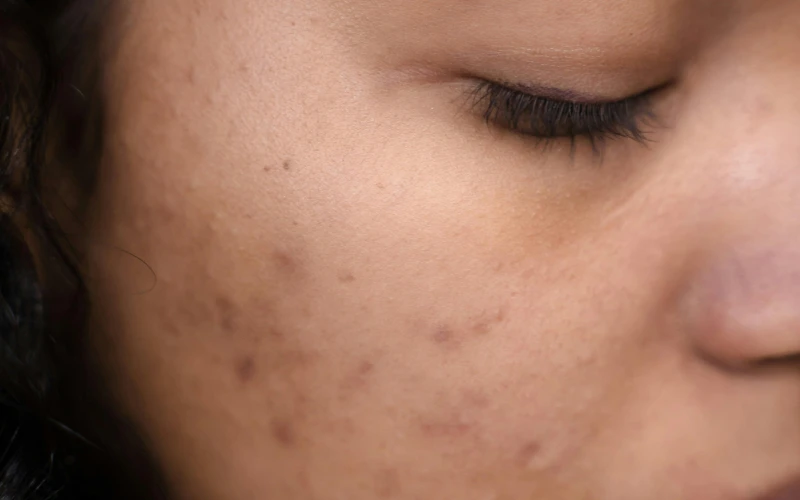 Close up of facial skin showing congestion during skin purging vs breakout adjustment period