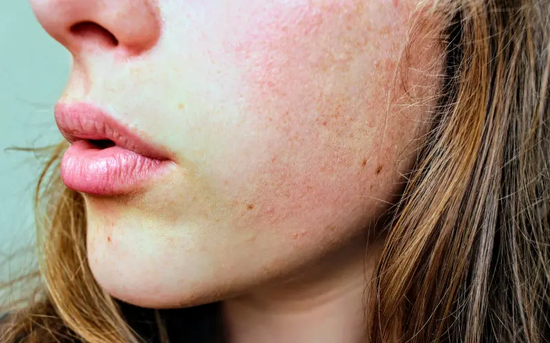 Keratosis pilaris on the face showing rough sandpaper-like bumpy texture across the cheeks