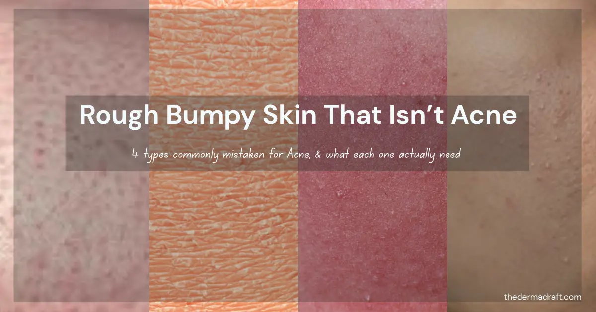 Close-up collage of four skin texture types commonly mistaken for acne, including closed comedones, milia, keratosis pilaris, and dehydrated skin